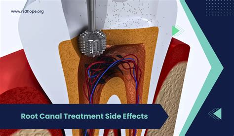 what causes the need for root chanel|root canal treatment side effects.